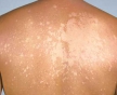 Фотодинамическая терапия может быть эффективна при себорейном дерматите и отрубевидном лишае