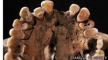 Антропологи обнаружили самые ранние следы зубных заболеваний у человека.