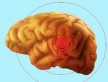 Лечение новообразований мозга возможно с помощью силы ультразвука