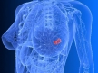 Получены положительные результаты КИ нового препарата против рака молочной железы