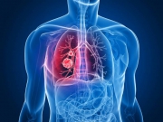  Современная терапия немелкоклеточного рака лёгкого:  как увеличить эффективность лечения?