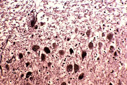 Нейрофибриллярные белковые клубки в мозжечке при синдроме Альцгеймера. (Фото Visuals Unlimited / Corbis)