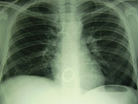 Рис. 5. Обзорная рентгенограмма органов грудной клетки пациента Ж., 13 лет. Биопротез трикуспидального клапана