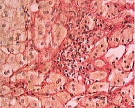 Рис. 8. Диффузный  перигепатоцеллюлярный  фиброз (увеличение в 500 раз)