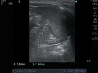 Рис. 1. УЗИ левого надпочечника мальчика в возрасте 1 мес. 1 день, родившегося на 25-й неделе гестации (диагноз: врожденная пневмония, бронхолегочная дисплазия), продольное сканирование в В-режиме: измерение ширины (А) и высоты (В) железы
