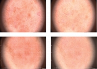 Рис. 4. Примеры дерматоскопической картины у пациентов после комплексного применения IPL-терапии (три процедуры), сыворотки и крема Liftactiv B3