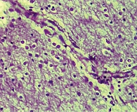 Рис. 7. Расширение посткапиллярных венул и вен ткани мозга с вакуолизацией адвентиции и периваскулярного пространства (окрашивание гематоксилином и эозином, увеличение 10 × 40)