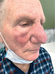 Рис. 8. Общий вид лица пациента справа через 12 месяцев после первого сеанса ФДТ: отечность и гиперемия кожи щек и лба разрешились