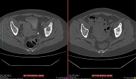 Рис. 3. Метастаз в теле подвздошной кости (слева) и его склерозирование после четырех месяцев терапии афатинибом (справа)