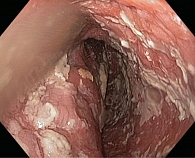 Рис. 2. Застойный кандидозный эзофагит на фоне ахалазии пищевода IV стадии (данные эндоскопической службы МКНЦ им. А.С. Логинова)