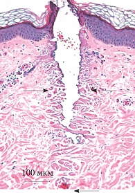 Рис. 1. Гистологическая картина эпидермиса  и дермы после воздействия лазера Fraxel re:pair. Зона абляции, окруженная «муфтой» коагуляции