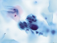 Рис. 3. Цитологическая картина эпителия шейки матки, соответствующая HSIL