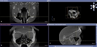 Рис. 2. 3D-КТ околоносовых пазух в трех проекциях на седьмой день после операции
