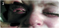 Рис. 2. Внешний вид больного до лечения (видны плотные, сероватые наложения на тарзальной конъюнктиве, выраженный отек и гиперемия век и конъюнктивы, общее раздражение глазных яблок, помутнение в оптической части роговицы справа)