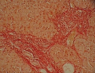 Рис. 9. Деструкция мелких желчных  протоков и пролиферация клеток  эпителия (увеличение в 500 раз)