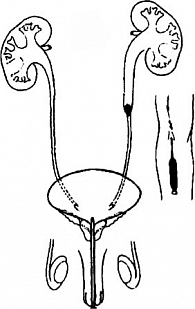 Рис. 2. Схема красочной пробы с индигокармином. Отток мочи и раствора индигокармина из левой почки нарушен конкрементом в средней трети моч