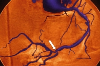 Рисунок 1. Стеноз правой коронарной артерии у больного сахарным диабетом типа 2 на коронарной ангиограмме