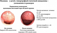 Рис. 1. Состояние аденоидных вегетаций до и после лечения