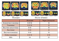 Рис. 12. Динамика изменений перфузии головного мозга у пациентов с МС  (n = 20) на фоне терапии Небилетом