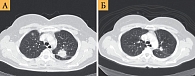 Рис. 2. Результаты компьютерной томографии, показывающие частичную регрессию первичного  очага на химиотерапии пеметрекседом и бевацизумабом: январь 2010 (А), январь 2014 (Б)