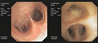 Рис. 1. Фибробронхоскопия с биопсией, подтвердившая рецидив опухоли в культе промежуточного бронха правого легкого