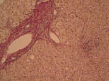 Рис. 4. Фиброз портальных трактов, окраска по Ван Гизону, увеличение в 250 раз