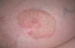 Подтверждены высокая эффективность и безопасность  такролимуса или пимекролимуса при атопическом дерматите 