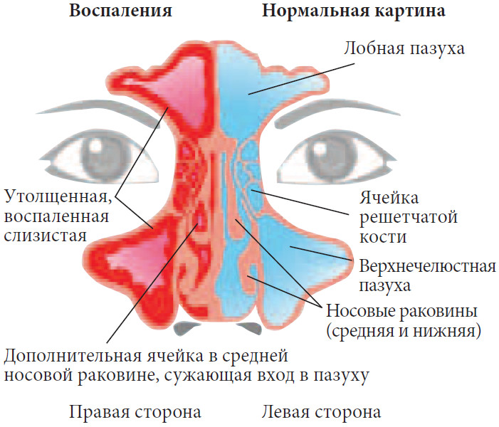 Гиперплазия слизистой верхнечелюстной