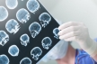 В МКБ-11 инсульт признали нарушением мозговой деятельности
