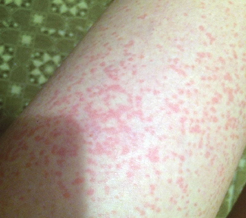 Henna allergic contact dermatitis