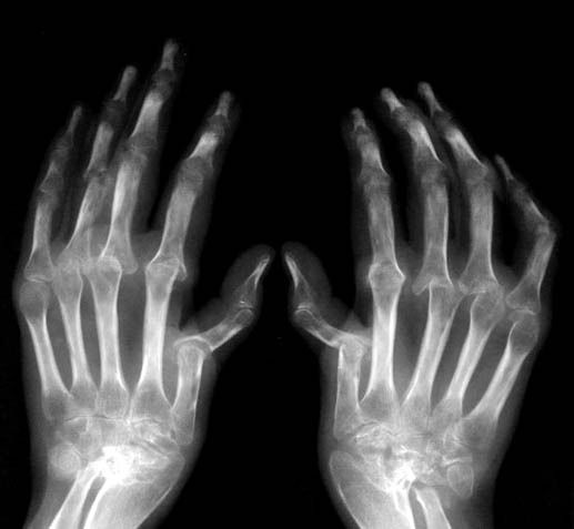В исследовании фазы IIа новейший лекарственный препарат ABBV-3373, конъгированное моноклональное антитело демонстрирует положительное влияние на активность заболевания у пациентов с ревматоидным артритом