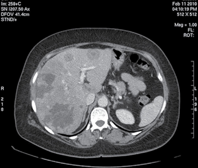 Рак молочной железы метастазы в легких. Метастазы молочной железы кт. Опухоль молочной железы на кт. Имплантационные метастазы в печени кт.