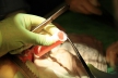 Трансплантация трахеи иностранному пациенту проведена в Краснодаре