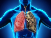 Уроки COVID-19: как не допустить новой эпидемии туберкулеза