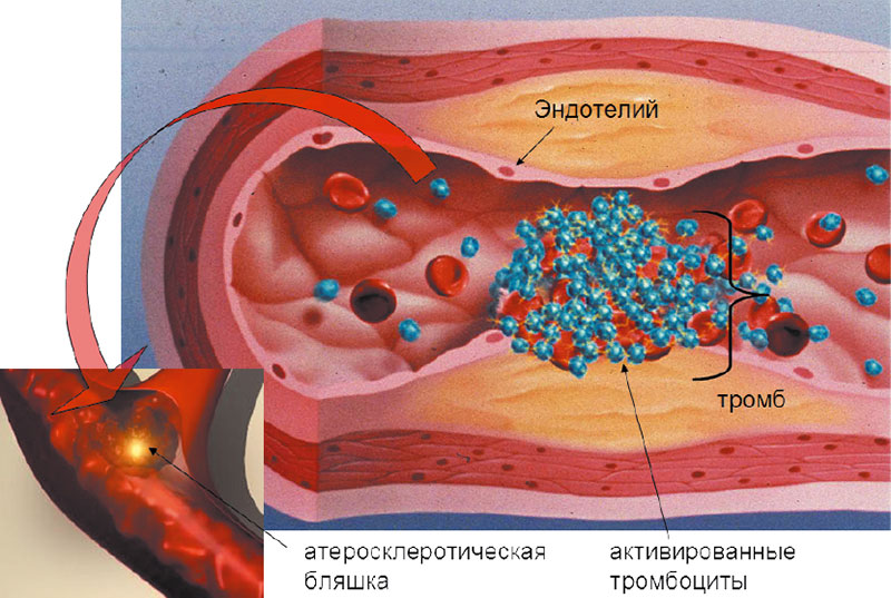 Атеросклеротическая бляшка рисунок