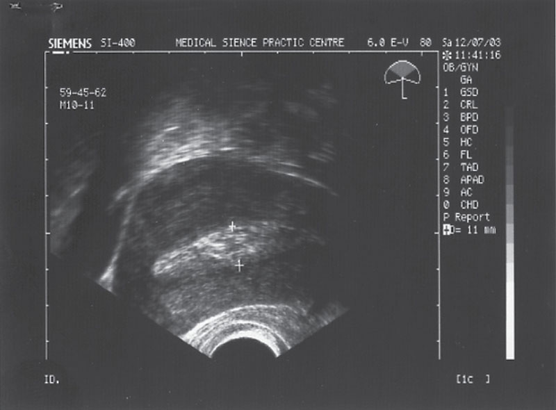 Беременность после вакуум аспирации замершей беременности. Толщина Мэхо эндометрия норма. Что такое м-Эхо:толщина 8мм. М-Эхо: 1.9 мм. УЗИ после медикаментозного прерывания беременности норма.
