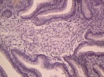 Рис. 11. Пенистые клетки в строме папиллярной аденомы, окраска гематоксилином и эозином, увеличение в 300 раз