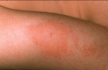 Кармин является причиной пищевой аллергии при атопическом дерматите