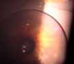 Клинический случай: купирование острого приступа глаукомы с помощью лазерных методов лечения