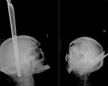 Красноярские врачи прооперировали человека с табуреткой в голове