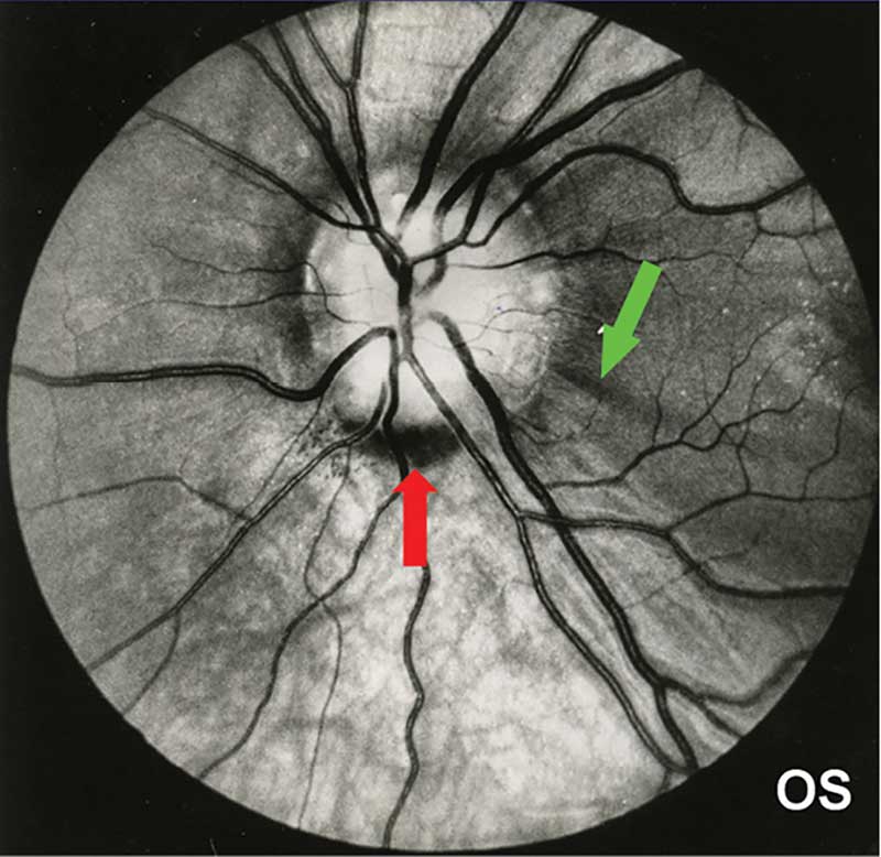 Расширение пространства зрительного нерва. Друзы диска зрительного нерва. Офтальмоскопия диска зрительного нерва.
