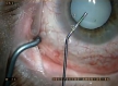 Операция на катаракте
