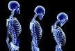 Ученые Сиднейского университета разработали препарат для лечения остеопороза