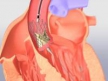 FDA одобрила протез аортального клапана CoreValve