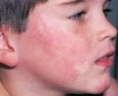 Получены  доказательства первичного поражения кожи у взрослых при парвовирусной инфекции
