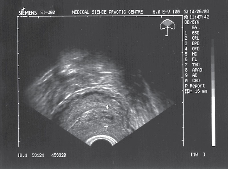 Фото плодного яйца после медикаментозного прерывания беременности