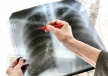Закон о принудительном лечении туберкулёза