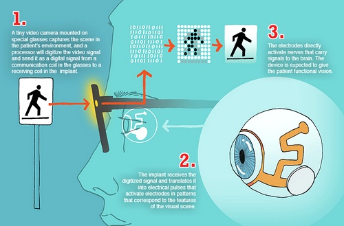 Схема работы устройства, имитирующего сетчатку и состоящего из внешней камеры и посаженного на глаз микрочипа, который стимулирует клетки глазного нерва (рисунок Florida International University).