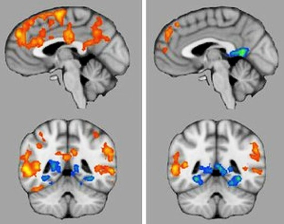 Мозговая активность у детей-аутистов становилась очень похожей на активность головного мозга нормально развивающихся детей