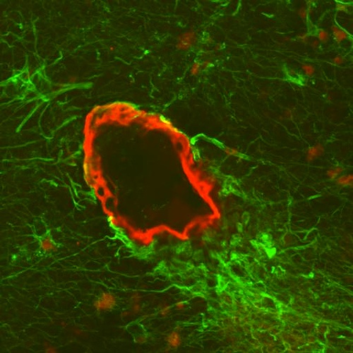 Кровеносный сосуд мозга, окружённый бета-амилоидными отложениями (фото Zerd).